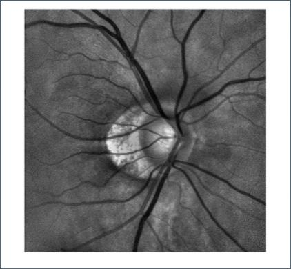 was connected to a Topcon TRC-50V fundus camera