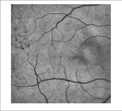 retinal images from the eyes of 2 diabetics and