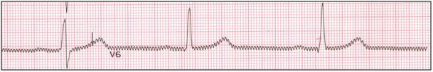 18 Kysymyksessä 30 vastaajat yrittivät tunnistaa EKG-käyrässä (kuva 6) olevaa häiriötä ja sen määrää. Oikea vastaus on, että EKG-käyrässä ei ole lainkaan häiriöitä. Kuva 6. Häiriötön EKG-kytkentä.