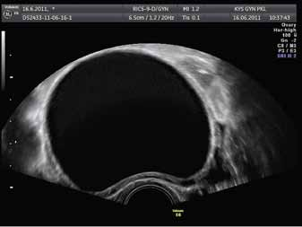 HYVÄNLAATUISET GYNEKOLOGISET KASVAIMET Taulukko 1. Erotusdiagnostisia kaikukuvauslöydöksiä. Kuva 2. Yksilokeroinen munasarjakysta.