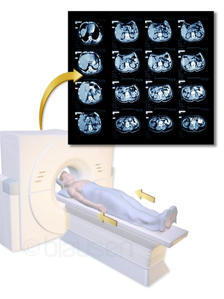 13 (44) Kuva 3 Cat Scan (WIKIPEDIA 2013-08-09). Läpivalaisukuvausta käytetään, kun tarvitaan reaaliaikaista, liikkuvaa kuvaa suonista, ruokatorvesta tai suolistosta.