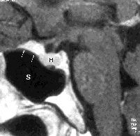 K u v a 4. Varjoainetehosteinen T1-painotteinen sagittaalisuunnan magneettikuva. Sellan etupuolella planum sfenoidalen päällä on sellan etuosaan ulottuva meningeooma (valkoiset nuolet).
