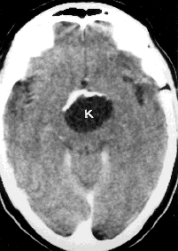 MK:n herkkyys adenoomadiagnostiikassa on arvioitavissa 85 90 %:ksi ja vastaavasti ilman varjoainetta tehdyn MK:n ja varjoainetehosteisen TT:n herkkyys 80 85 %:ksi (Elster 1993a, b).