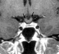 Aivolisäkkeen takalohko (musta nuoli) näkyy normaalina signaalinvoimistumana. kauden aikana tai synnytyksen jälkeen (kuvat 8 A, B). Kyseessä on ilmeisesti autoimmuunitapahtuma.