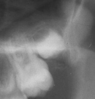 PNS = Posterior Nasal Spine A = A-piste (Subspinale) Yläleuan luun tain