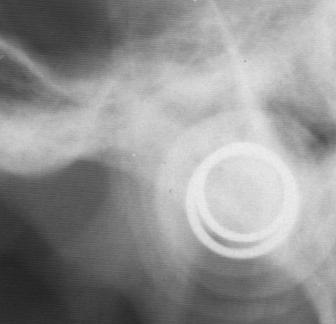 Tgo = konstruoitu Gonion TM = Temporomandibular Joint, leukanivel Mandibulaaritason ja ramustason leikkauspiste.