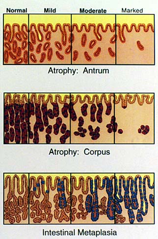 hyperplasia niukka lymfosyyttireaktio 2.