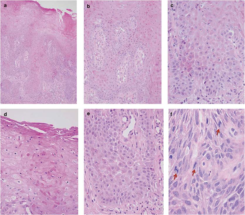 Luokitusperusteita Sivu 184 Low-power overview of differentiated VIN (a) with the five most important histopathological characteristics that can be recognized in an H&E stain: elongated rete ridges