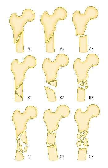 9 stabiileihin ja instabiileihin. Subtrokanteerisissa murtumissa luokituksia on useita, tavallisin niistä on AO-luokitus (Kuva 1).