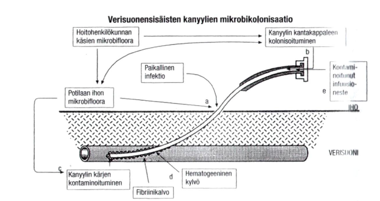 KUVIO 1. Verisuonensisäisten kanyylien mikrobeille altistuminen. (Kotilainen, Terho & Kurvinen 2010, 272.