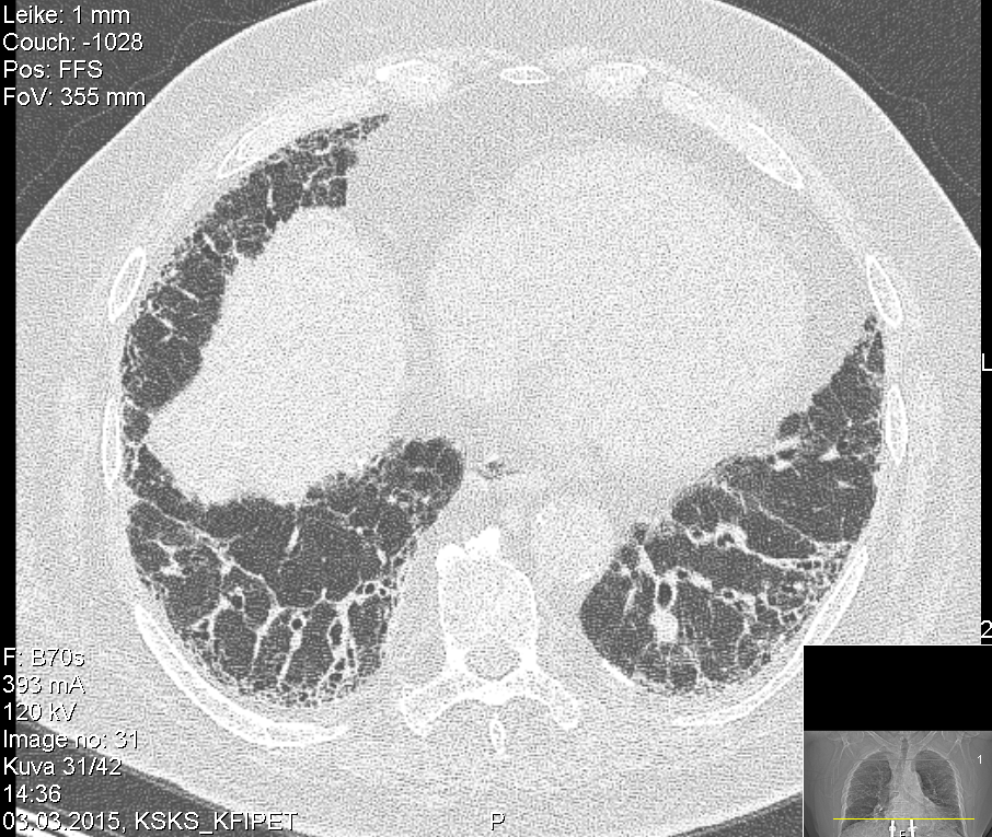 09.02.2017 Kontrolli keuhko pkl:lla 3/2015 Vertailussa 15.9.2014 kuvaus Kyllä tällä taudilla on progressiotaipumus.