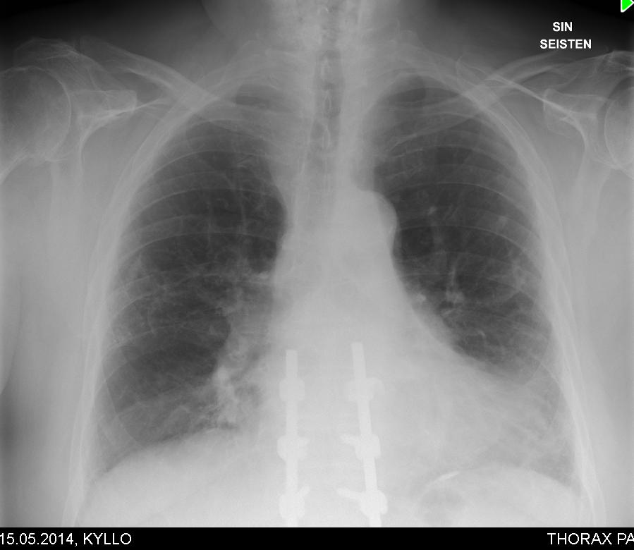 Potilastapaus Lähete KEU pkl 8/2014 pitkittynyt limaisuus ja fibroosi 74v mies RR, DM II, TULES, 2011 selkäleikkaus, keuhkoembolia, kivessyöpä -68, uniapnea Lähinnä limaista yskää 2-3kk ajan