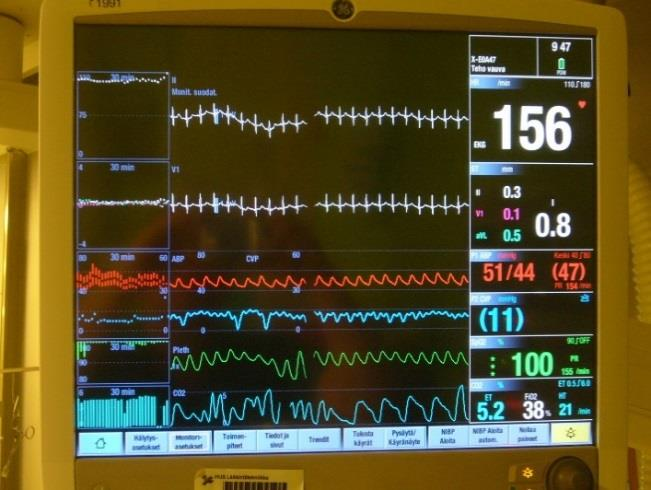 45 Kuva 26. Hiilidioksidimittaus näytöllä 10 HENGITYSKONEEN KULJETTAMINEN JA AKUT Hengityskonetta kuljetettaessa varmista, että potilasyksikkö ja monitori on kiinnitetty kunnolla ja lukittuna.