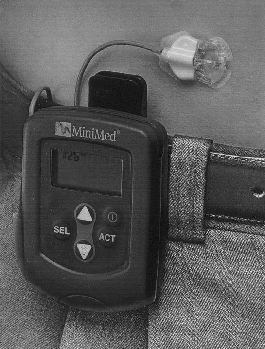 Verensokeriseurannan kehitys (4) Seuranta verestä CGMS In 1999, MiniMed received FDA approval for it's CGMS system
