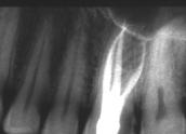 Malletin esittämä kliininen tapaus: Preoperatiivisissa röntgenkuvissa näkyy UL6:ssa sekundaari-pulpitis sekä karioottinen leesio distaalisesti (eksentraalinen ja sentraalinen tapaus).