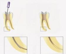 Sensijaan kanavan kervikaalisin osa ei laajene näin laajaksi, jolloin hammaskudosta säästetään muulta alueelta Ota masterpoint-kuva Täytä juurikanava, kun se on laajennettu riittävän laajaksi