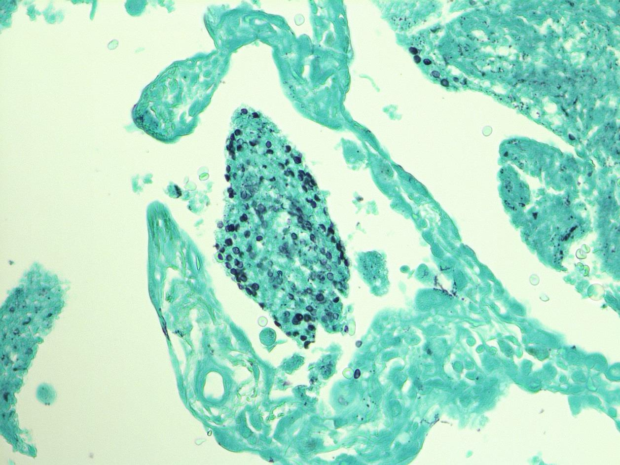 20 Pneumocystis jirovecii osoitetaan keuhkohuuhtelunäytteestä, indusoidusta yskösnäytteestä, suun huuhtelunäytteestä, transbronkiaali- tai keuhkobiopsiasta immunofluoresenssivärjäyksellä,