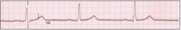 17 tulisi maata rentona ja mahdollisimman liikkumatta. EKG-rekisteröijän tulee myös tarkistaa, ettei potilas koske esimerkiksi sängyn metalliosiin, sillä tästä voi syntyä häiriötä EKG-käyrään.