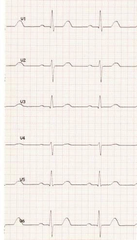 Liite 2 4 En tiedä vastausta. Vastaus on: Seuraavat EKG-koneitten kirjoittamat viestit EKG-käyrässä kuvaavat ongelmia rekisteröintitilanteessa.