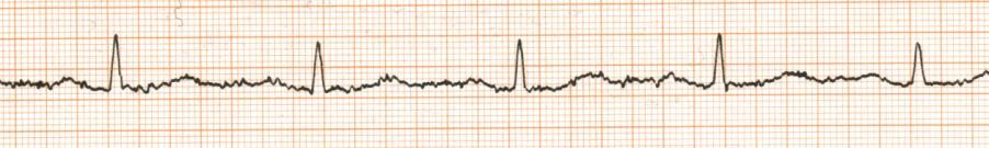 Liite 2 5 9 Toisesta sähkölaitteesta. 10 Muusta/ muista syistä, kuten: 17) Tiedätkö, miten vaihtovirtahäiriö muodostuu EKG-käyrään. 1 En tiedä 2 Tiedän.