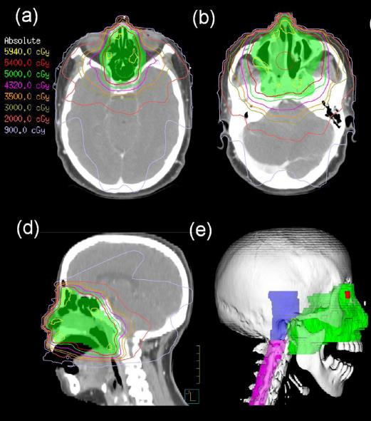 Seuraavat piirto-ohjeet koskevat pääasiassa nodaalisia lymfoomia, mutta Extranodaalisten osalta ILROGin (International Lymphoma Radiation Oncology Group) tuore suositus: Yahalom, Illidge, Specht et