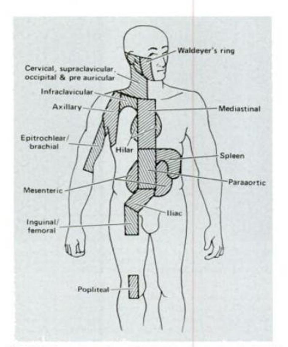 Levinneisyysluokittelun (HL) imusolmukealueet,