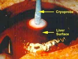 Cancers Skin Cervix (precancerous)