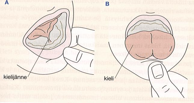 26 KUVA 4. Kireä kielijänne (Deufel & Montonen 2010, 277) Useimmiten vauva, joka kärsii kireästä kielijänteestä, oppii imemään rinnasta. Tällöin kuitenkin tarvitaan harjoittelua ja tehokasta ohjausta.