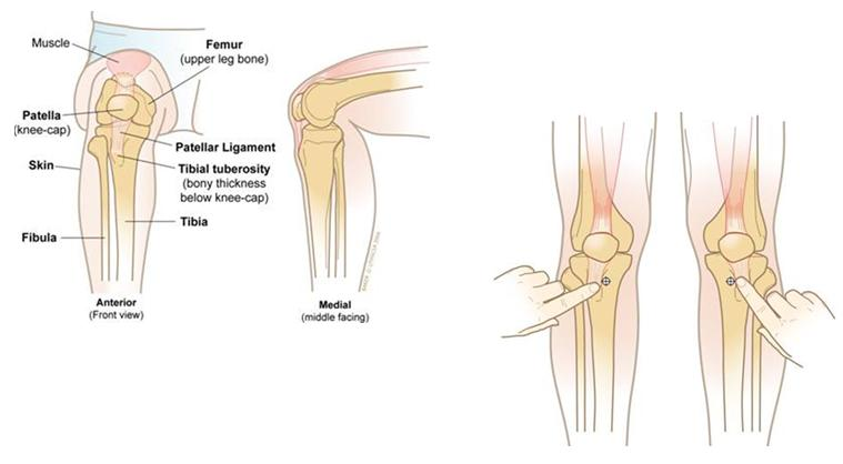 21 Kuva 6. Proksimaalinen tibia (Kuva: Medidyne).