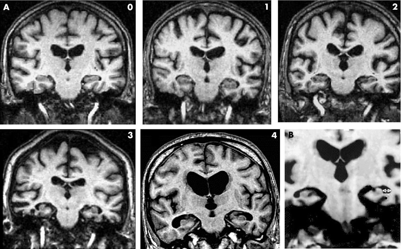 Kuva 3 MRI - Scheltensin luokitteluasteikko 0-4.