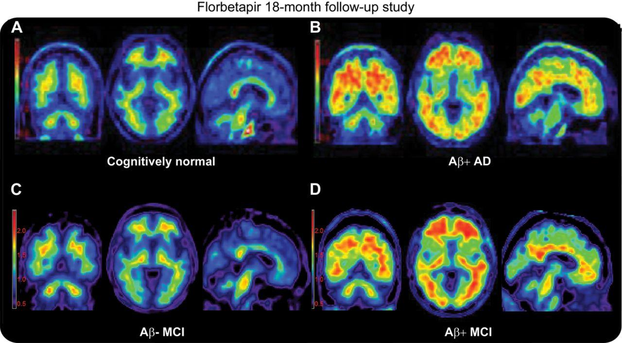 Kuva 5 PIB PET - beta-amyloidikertyminen A:normaalilla, B:Alzheimer potilaalla, C:Lievä kognitiivinen heikentymä (ei vielä beta-amyloidikertymää), D:lievä kognitiivinen heikentymä(jossa jo