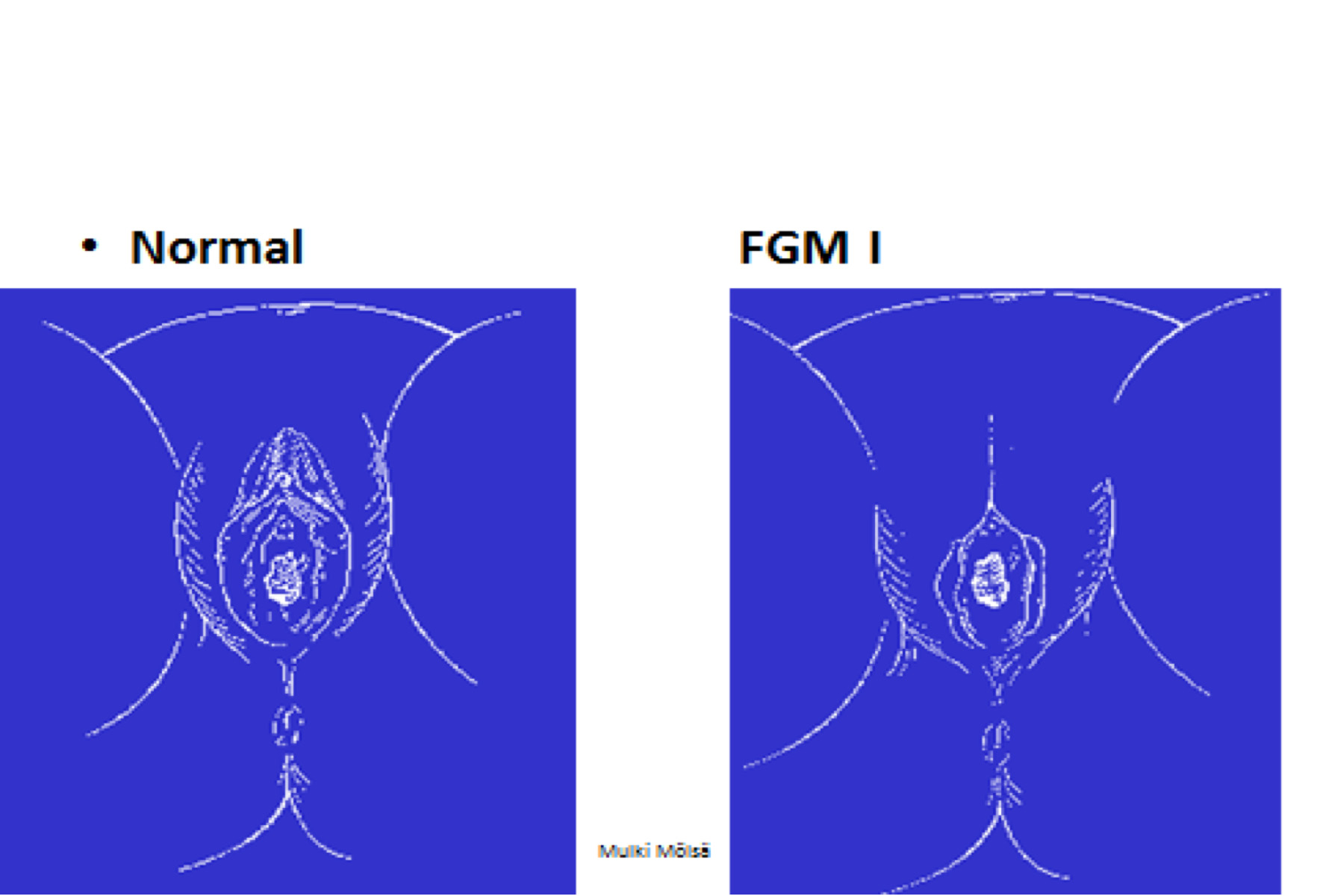 Tyttöjen ympärileikkaamista on neljää perustyyppiä. Lievimmässä muodossa saattaa riittää neulan pisto, viilto, raaputus, lävistys tai polttaminen klitorikseen pienen veritipan saamiseksi (FGM IV).
