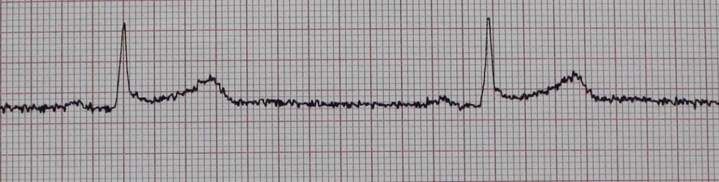 15 (42) 2004, 18). EKG-artefakti on EKG-käyrässä havaittava muutos tai löydös, joka ei ole peräisin sydämen sähköisestä toiminnasta.
