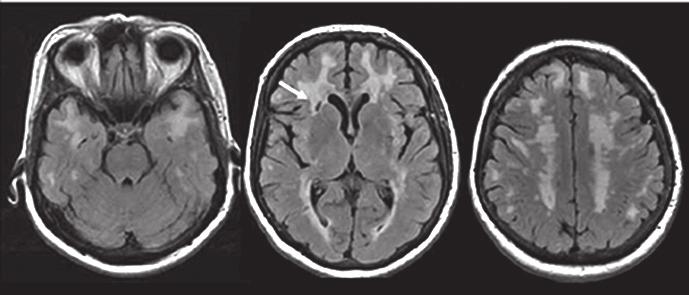 III Neurologisiin sairauksiin ja oireyhtymiin liittyvät kognitiiviset oirekuvat Kuva 6.