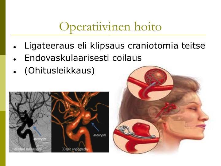 12 Kuva 2: Aivovaltimopullistuman neurokirurginen hoito (Neurokirurgian klinikka 2015) Aneurysman klipsauksen tai koilaamisen jälkeen varmistetaan potilaan normovolemia, lievä hemodiluutio eli veren