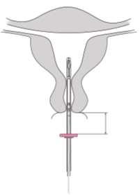 4. Medan glidaren hålls i sitt toppläge, för insättningsröret genom cervix tills ringen/markören är ca 1,5-2 cm från cervix/portio (bild 4). Bild 4 1,5-2,0 cm VIKTIGT! Forcera inte vid stort motstånd.