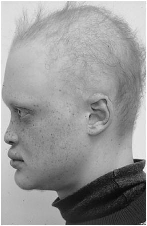 Associated defects Gene Type of molecule Hypohidrotic ectodermal dysplasia (HED) EDA EDAR EDARADD Signal molecule, EDA