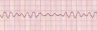 10 SR eli Sinus rhythm eli Sinusrytmi Sinusrytmi on sydämen luonnollinen sähköinen rytmi. Sydän tahdistuu normaalisti sinussolmukkeesta. Verenkierto on normaali. (Kuisma ym.
