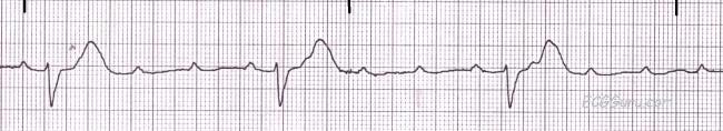 EKG VAAKASUUNNASSA EKG:n vaakataso = AIKA (miten kauan impulssilla kestää) Mitä LEVEÄMPI kukin poikkeama on, sitä