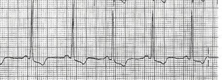 EKG PYSTYSUUNNASSA EKG:n pystytaso = JÄNNITE (jota nostaa mm.