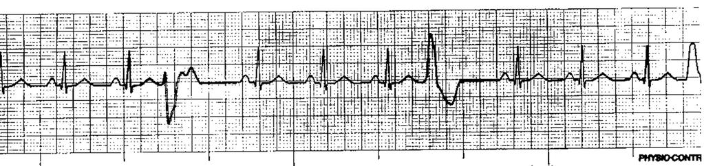 QRS-KOMPLEKSI Leveys >0,12s =leventynyt (Haarakatkos? Kammiorytmi? Delta-aalto?) Poikkeava muoto?