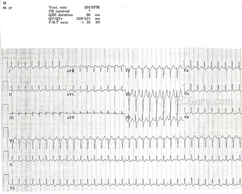 POTILASTAPAUS 1 (EKG) 21/4/17