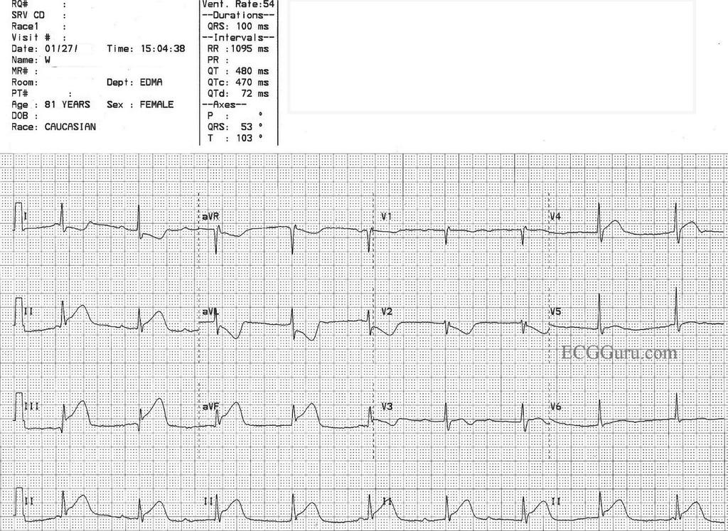 POTILASTAPAUS 3 (EKG) 21/4/17