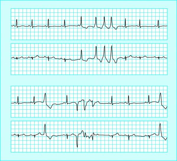 POTILASTAPAUS 4 (EKG) 21/4/17