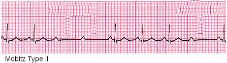 POTILASTAPAUS 5 (EKG) 21/4/17