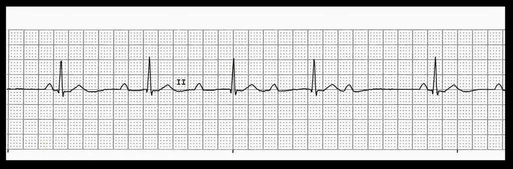 POTILASTAPAUS 12 (EKG) 21/4/17