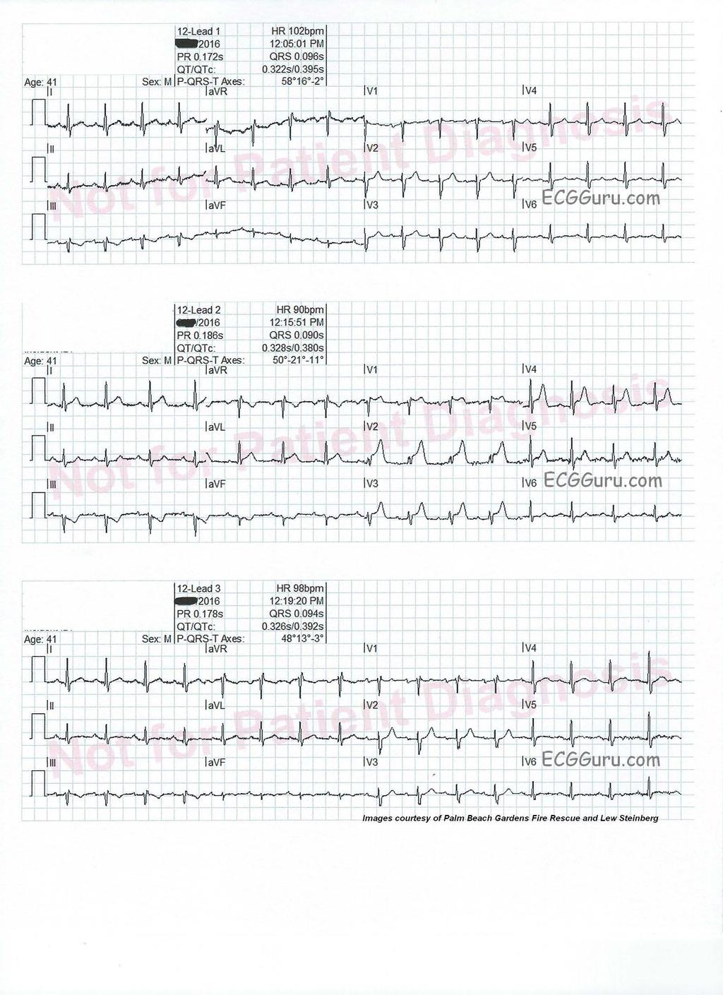 POTILASTAPAUS 13 (EKG) 21/4/17