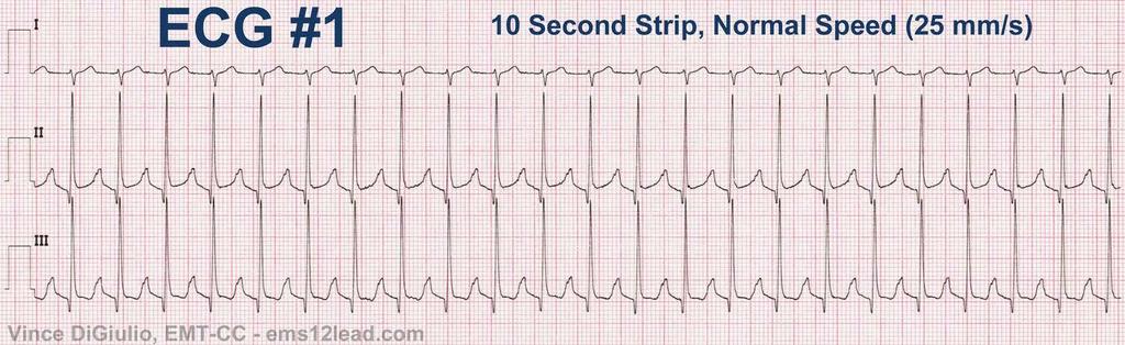 POTILASTAPAUS 15 (EKG) 21/4/17