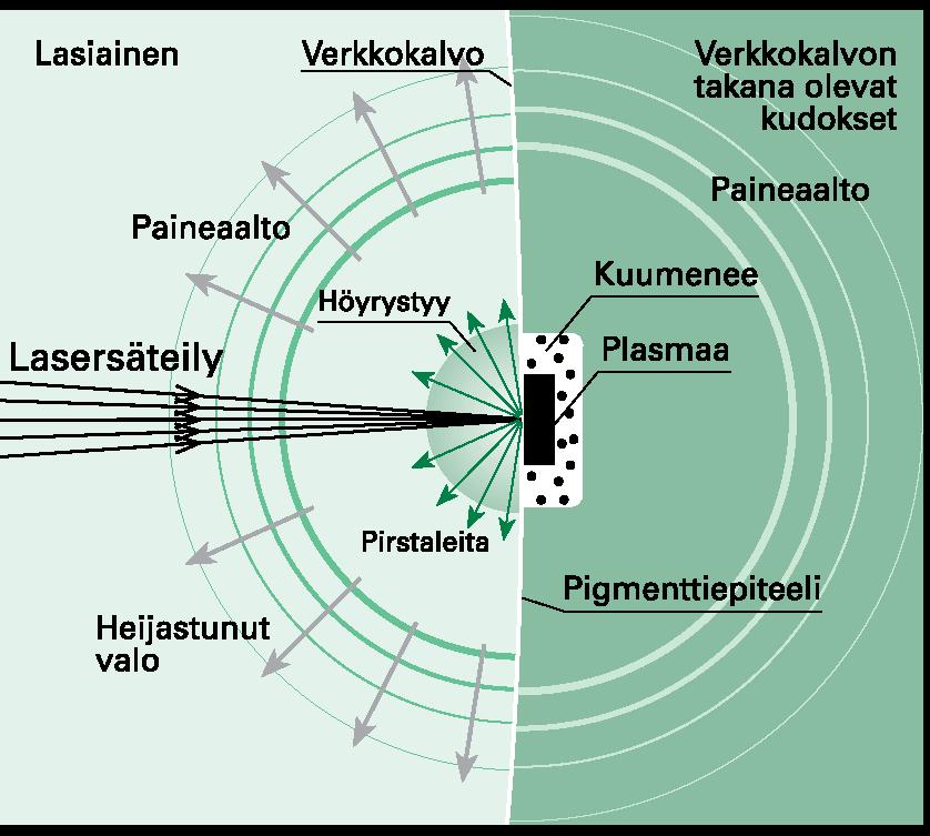 Lyhyen laserpulssin vaikutuksia silmään näkyvän