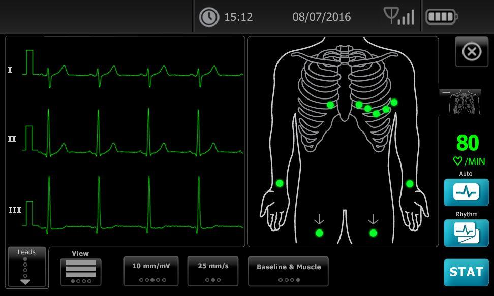 24 EKG-tutkimukset CP 150 12-kytkentäinen lepopulssia mittaava elektrokardiografi 5. Kiinnitä elektrodit potilaaseen.